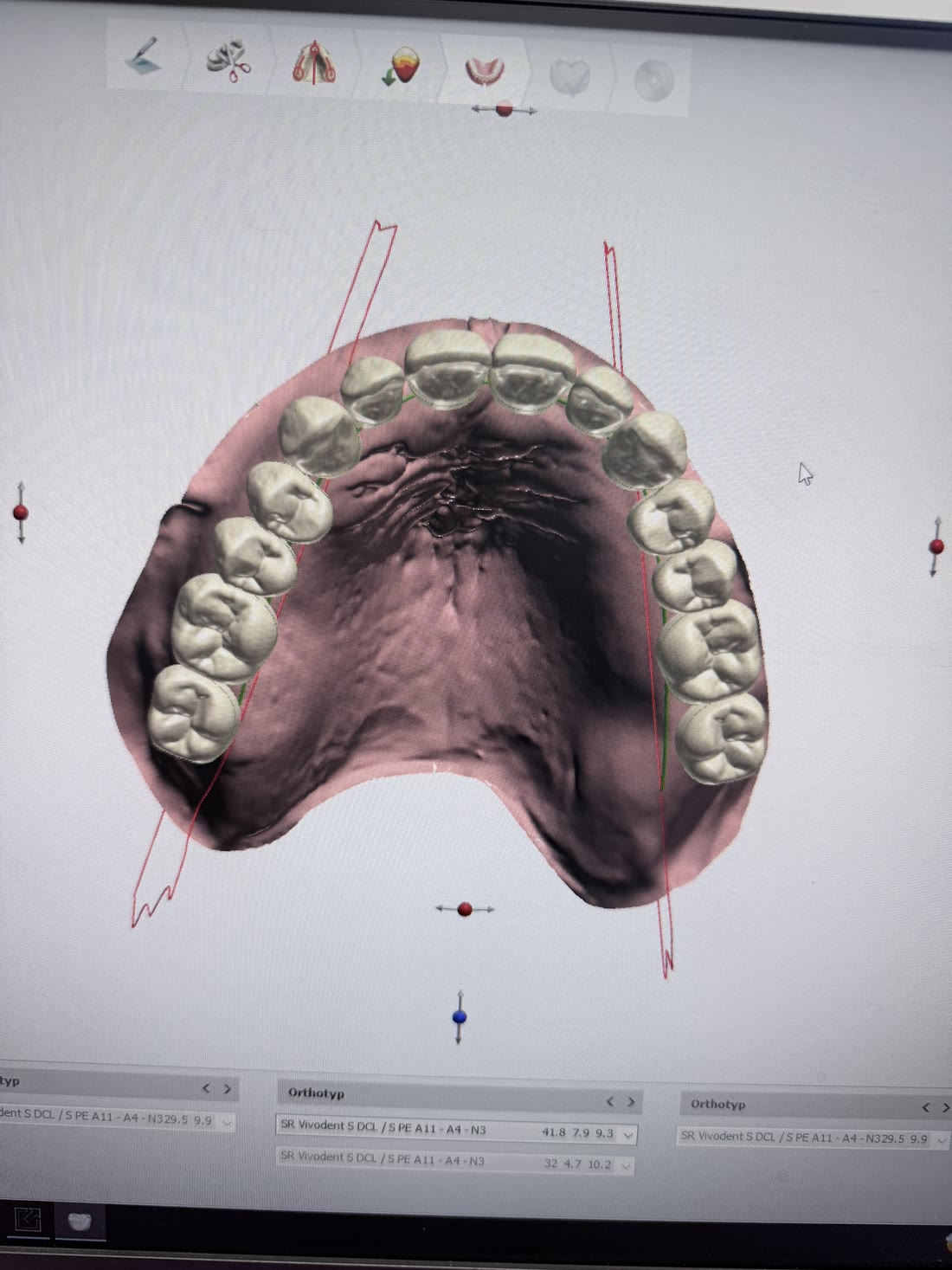 A denture design on a computer screen